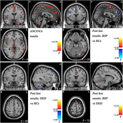 Comparing Brain Functional Activities in Patients With Blepharospasm and Dry Eye Disease Measured With Resting-State fMRI